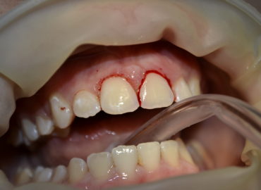 GINGIVECTOMIE