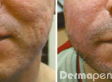 Dermapen