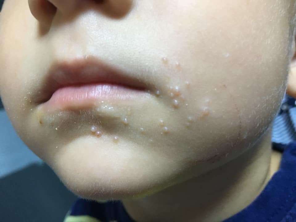 Molluscum contagiosum