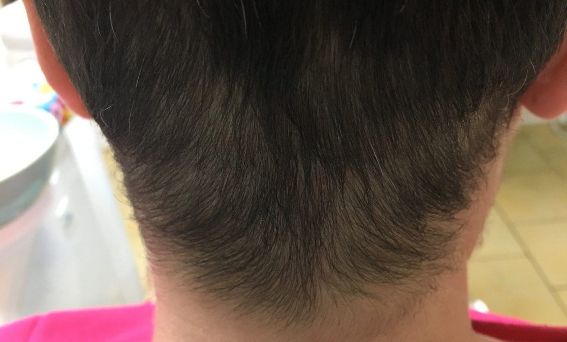 Alopecie Areata - pelata - Activ Dent Constanta