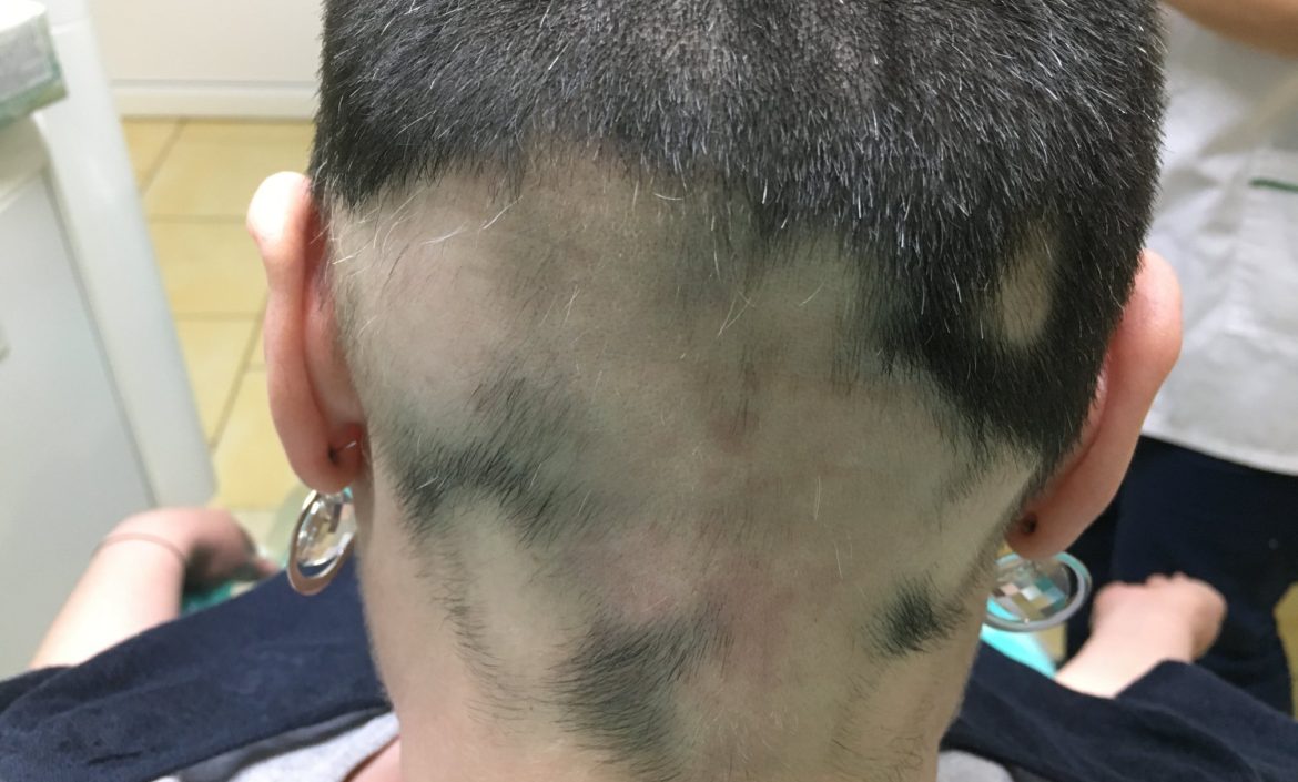 Alopecie Areata - pelata - Activ Dent Constanta