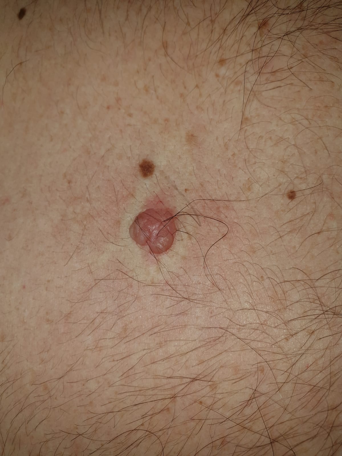 Nev papilomatos torace posterior